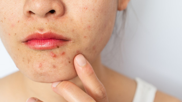 Acne Awareness Month: Doctor shares tips on treating acne